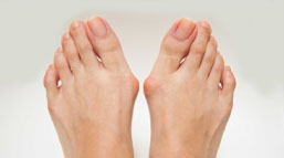 hallux valgus