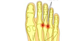 morton neuralgie pijn middenvoet